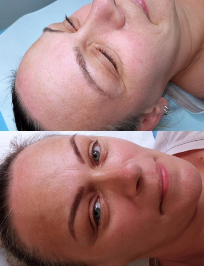 Korekcija starih obrva microblading tehnikom